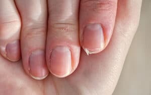 Close up of dry, brittle nails from low levels of thyroid hormones