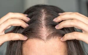 Woman with thinning hair from hypothyroidism